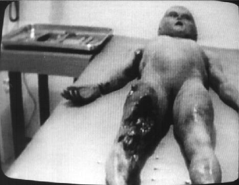 Santilli-Krper vom Fuende her